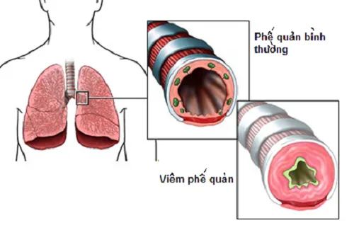 Hình ảnh phế quản bình thường và viêm phế quản cấp